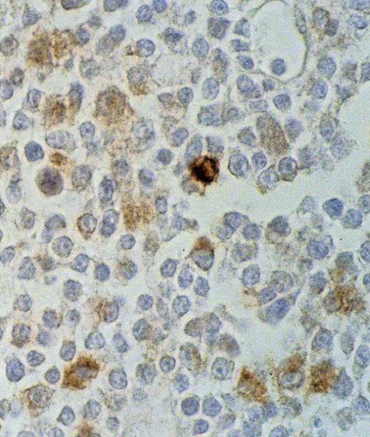Fig. 3. BCL-2 protein expression in a case of AIDS-related PCNSL (DLCL). The microphotograph shows that the tumor consists of large tumor cells with immunoblastic morphology. BCL-2 positivity is manifested as cytoplasmic staining in several tumor cells. Paraffin-embedded tissue section, ABC-px immunostaining and tyramide amplification, hematoxylin counterstain. Original magnification × 250.