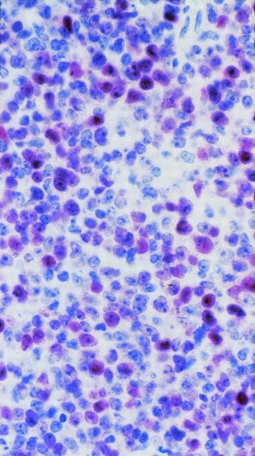 Fig. 4. BCL-6 protein expression in a case of AIDS-related PCNSL (DLCL). The microphotograph shows that the tumor is relatively monomorphous and predominantly consists of large tumor cells displaying a large noncleaved cell morphology. Several tumor cells display the characteristic nuclear positivity for BCL-6. Paraffin-embedded tissue section, APAAP immunostaining, hematoxylin counterstain. Original magnification × 250.