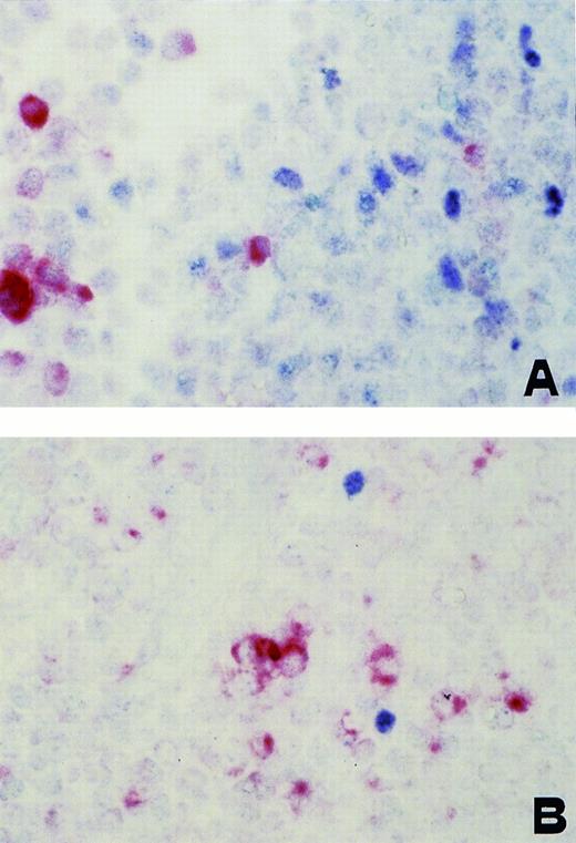 Fig. 5. AIDS-related PCNSL (DLCL). Two-color staining. (A) In this microphotograph, several tumor cells exhibit nuclear staining (blue) for BCL-6 and few cells show a strong cytoplasmic and membrane staining (reddish) for LMP-1. No coexpression of both markers by the same tumor cell is detectable. (B) Microphotograph of a different field in which there is a prevalence of LMP-1+ cells with few BCL-6+ nuclei. No coexpression is detectable. Paraffin-embedded tissue section, no counterstain. Original magnification × 400.