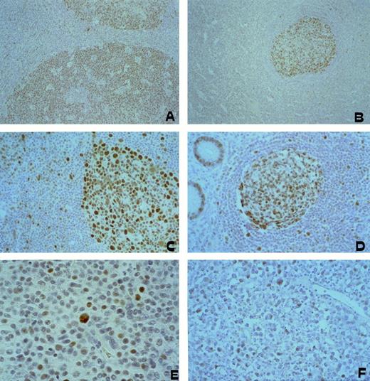 Fig. 6. hMSH2 expression in reactive secondary B-cell follicle in lymphnode (A), spleen (B), appendix (C), and palatine tonsil (D). hMSH2 is a nuclear located protein selectively expressed by follicular germinal center B cell; the mantle, paracortical, and marginal zones appear hMSH2 negative with the exception of large secondary blasts that are crossing the mantle. (E) AIDS-related PCNSL; (F) AIDS-unrelated PCNSL. Most neoplastic cells show a nuclear staining pattern with anti-hMSH2 MoAb. Paraffin-embedded tissue section, ABC-px immunostaining, hematoxylin counterstain. Original magnification × 100 (A), (B), × 250 (C through F).