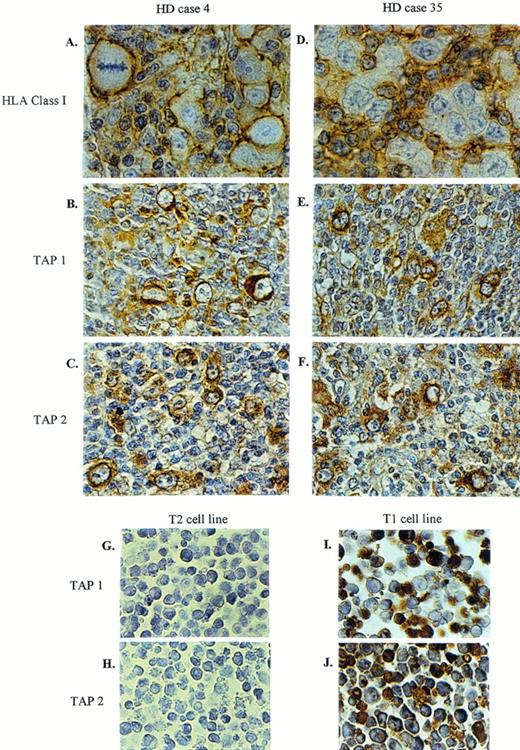 Fig. 1. Two representative HD cases stained for HLA class I, TAP 1, and TAP 2. Biopsy material from HD case No. 4 expresses high levels of HLA class I (A), as well as TAP 1 (B) and TAP 2 (C). HD case No. 35 shows no detectable HLA class I (D), whereas TAP 1 (E) and TAP 2 (F) are expressed. Sections were counterstained with hematoxylin. T2 (TAP-negative cell line) and T1 (TAP-positive cell line) were used as controls for TAP 1 (G, I) and TAP 2 (H, J) staining. Original magnification × 672 (A, D) and × 420 (B, C, E-J).