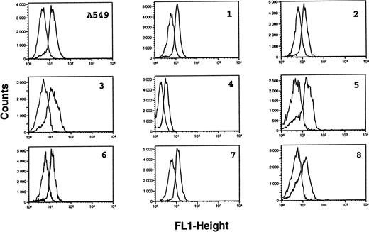 Fig. 2. Analysis of iNOS protein expression in B-CLL cells by flow cytometry. B-CLL cells from eight different patients and A549 cells (positive control for iNOS expression) were permeabilized with the Cytoperm kit and labeled with either the monoclonal anti-iNOS (clone 54) or unrelated IgG1 MoAb as an isotype-matched control, then incubated in the presence of a fluoresceinated goat F(ab′)2 anti-mouse Ig antibody. Fixed cells were analyzed by flow cytometry with a FACScan instrument, using the lysis II and Procyt softwares. Gray line, control labeling with IgG1; black line, labeling with anti-iNOS. The statistical significance was P < .001, according to the Kolmogorov-Smirnov test and the data are representative of a total of 13 different B-CLL cell samples tested.
