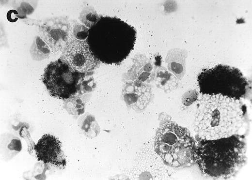 Fig. 6. Anti-TNF–treated GTS cultures contain myeloid progenitors with CFU potential on day 10. Cells removed from anti-TNF–treated GTS cultures on day 10 and placed in methylcellulose with GM-CSF+SCF yielded colonies resembling mono CFU (a) and granulocyte CFU (b). Nonspecific esterase (c) and Wright stain (d) analysis confirmed the presence of both mono-macrophages and granulocytes. Original magnification for (a), (b), and (d) = 40×, for (c) = 60×. Cells removed from untreated GTS cultures on day 10 and cultured in parallel failed to yield CFU.