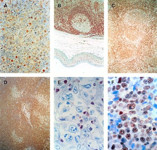 Fig. 1. Immunostainings of cyclin E and p27 in normal lymphoid tissues and malignant lymphomas. (A) Cyclin E staining in an indolent lymphoma showing both nuclear and cytoplasmic reactivity. (B) p27 staining of a reactive follicle in a tonsil. Notice the staining pattern in the dark and light zone. (C) p27 staining of a malignant follicular in an FL lymphoma. The staining pattern is representative for indolent lymphomas. (D) CLL with p27−pseudofollicles. (E) Large cell lymphoma with p27−blastic cells and occasional positive small lymphocytes (S-phase fraction = 11.5%). (F) Large cell lymphoma with p27+(S-phase fraction = 3.4%).