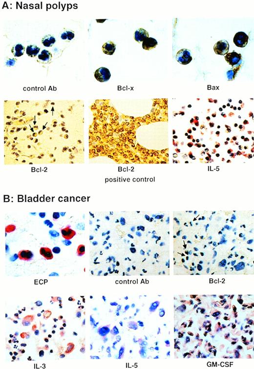 Fig. 3. Bcl-x and Bax, but not Bcl-2, proteins are significantly expressed by eosinophils in eosinophilic tissues. (A) Immunohistochemical staining with the indicated antibody using nasal polyp tissues. Bcl-x and Bax, but not Bcl-2, proteins were detectable in tissue eosinophils. In the Bcl-2 panel, some representative eosinophils are marked with arrows. The Bcl-2+ control was bone marrow tissue from a patient with a B-cell lymphoma. Moreover, IL-5 protein was highly expressed in nasal polyp tissues. (B) Staining of tissue infiltrated by bladder cancer cells as well as eosinophils. Again, eosinophils expressed no detectable Bcl-2 protein (see cells marked with an arrow in the third panel), although high levels of the eosinophil hematopoietins were present in this tissue.