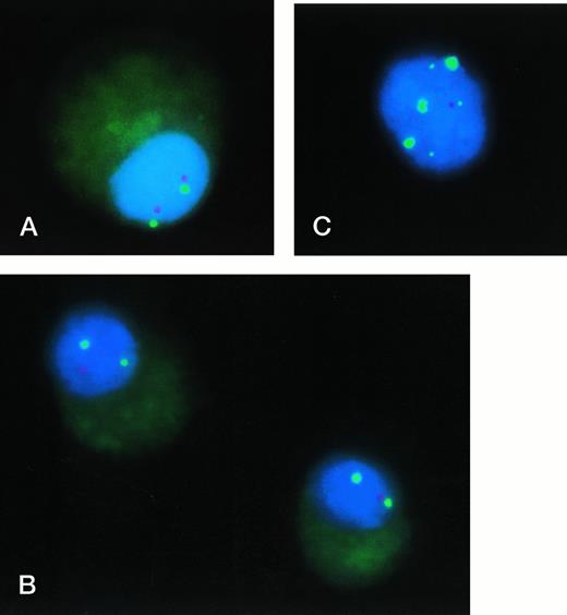 Fig. 2. Interphase FISH analysis of the p53 gene in MM: (A) Plasma cell from a patient without p53 deletion: Two hybridization signals with both probes (chromosome 17 centromere, green signals; p53, red signals) can be recognized. (B) Plasma cells from patient 3/FJ (Table 2) exhibiting a monoallelic deletion of p53 (probes as in A). (C) Interphase cell of patient 2/NN (compare Table 2: trisomy 17 by metaphase cytogenetics) hybridized with 3 probes: Chromosome 17 centromere (labeled with SPECTRUM-Green; large green signals), p53 (labeled with SPECTRUM-Orange; red signal), and distal 17p (D17S34 locus, labeled with digoxigenin and visualized with anti-digoxigenin-fluorescein isothiocyanate; small green signals). Presence of three signals for chromosome 17 centromere andD17S34, but only one signal for p53 indicating an interstitial deletion on 17p involving the p53 locus.