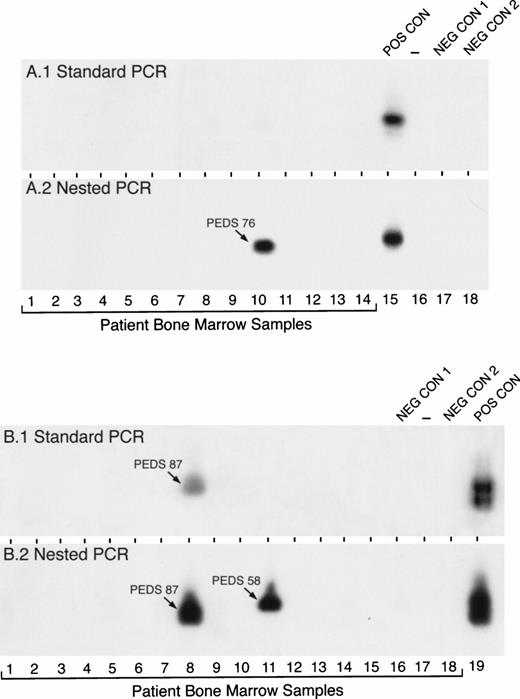 Fig. 2. Detection of MLL-AF4 fusion transcripts in pediatric ALL BM specimens by standard and nested RT-PCR. RNA samples from primary leukemic cells of 32 (A, 14 patients; B, 18 patients) newly diagnosed pediatric ALL patients were examined forMLL-AF4 fusion transcript expression by standard RT-PCR (A1 and B1) and nested RT-PCR (A2 and B2). PEDS 76 shown in A.2 was a normal diploid case (see Tables 3 and 6). PEDS 87 shown in B.1. and B.2 was a hyperdiploid t(4;11) ALL case and PEDS 58 shown in B.2. was a hyperdiploid non-t(4;11) case with del(11)(q23) (see Tables 3 and 6). Amplified mRNA from the RS4;11 cell line was used as a positive control (POS CON). Negative controls were PCR products from RNA-free reaction mixture 1 plus reaction mixture 2 (NEG CON 1) and reaction mixture 1 plus DNA polymerase-free reaction mixture 2 (NEG CON 2).