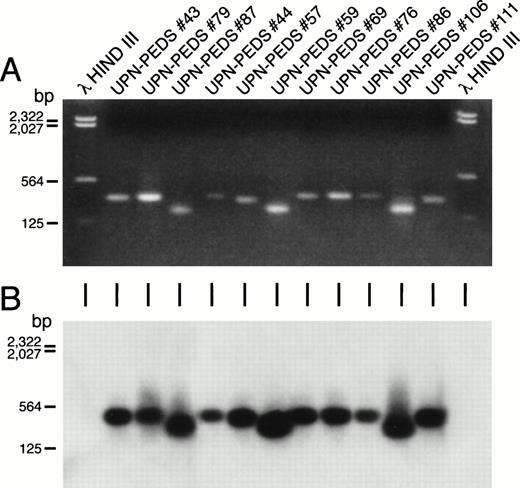 Fig. 3. Detection of MLL-AF4 fusion transcripts in non-t(4;11) leukemic cells by PCR. Ethidium bromide–stained gel (A) and Southern blot (B) of the PCR reaction products from ALL patients who lack cytogenetically detectable t(4;11). First and last lanes contain molecular size markers. UPN-PEDS 69, 76, 86, and 106 had normal diploid karyotypes. UPN-PEDS 79 had a pseudodiploid karyotype. UPN-PEDS 43, 44, 57, and 59 had hyperdiploid karyotypes with structural abnormalities. UPN-PEDS 111 had hyperdiploid karyotypes without structural abnormalities. UPN-PEDS 87, a patient with t(4;11), was included as a positive control (see Tables 3 and 6).