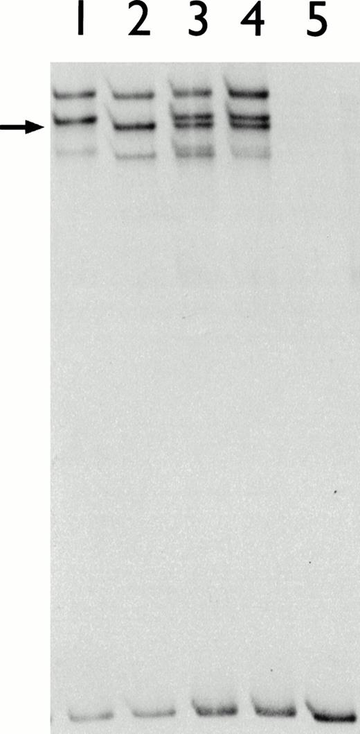 Fig. 2. PCR-SSCP analysis of exons 3 and 4 of the factor VII genes of: lane 1, normal control; lane 2, affected child (IV.2); lane 3, father (III.5); lane 4, mother (III.6); lane 5, double-stranded control. An arrow indicates extra band with altered migration, when compared with normal control bands.