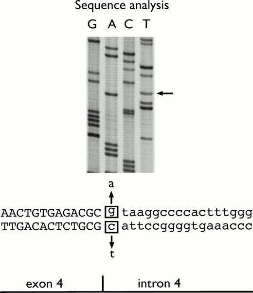 Fig. 3. Nucleotide sequence of mutant DNA spanning exon 4 and intron 4 of the gene for FVII. The DNA was sequenced by the dideoxy chain termination method after subcloning into Bluescript plasmid vector (Stratagene, Cambridge, UK). The antisense sequence is shown. An arrow indicates the mutated base.