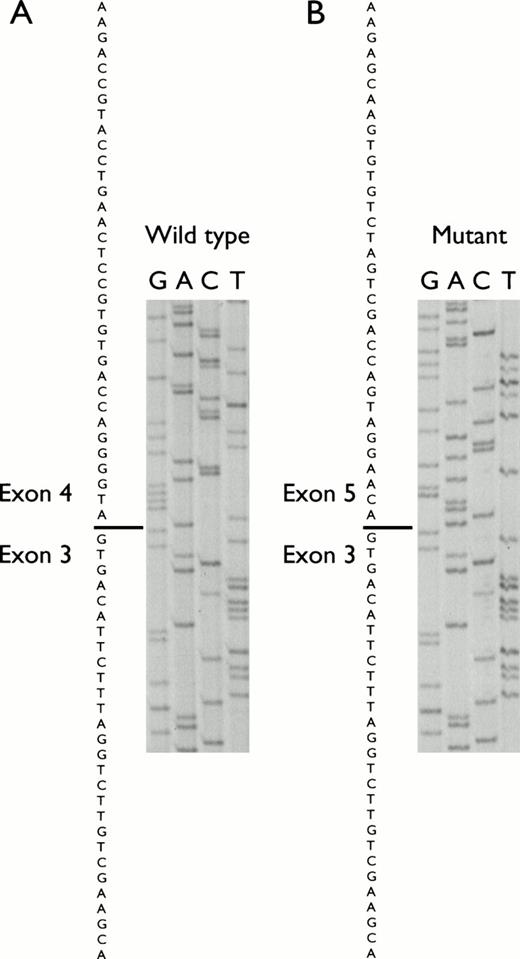 Fig. 5. Nucleotide sequence of the exon 3-exon 5 splicing variant observed in RT-PCR analysis of ectopic transcripts in lymphocytes from the parents. (A) Normal allele, (B) mutant allele.