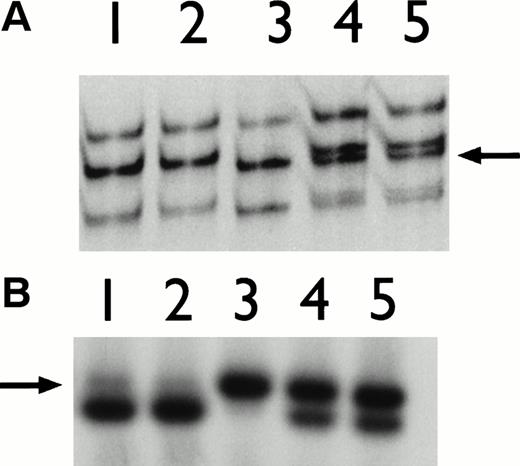 Fig. 7. (A) PCR-SSCP analysis. (B) Restriction endonuclease analysis of exons 3 and 4 including intron/exon junctions. Lane 1, chorionic villus sample (IV.3); lane 2, normal control; lane 3, affected child (IV.2); lane 4, father (III.5); lane 5, mother (III.6). An arrow indicates extra band with altered migration, when compared with normal control bands.