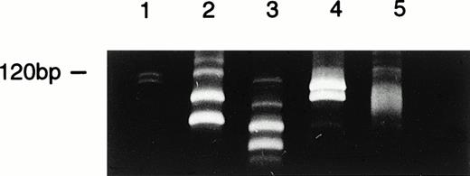 Fig. 3. Clonal evolution identified by FRA3/JH PCR at various stages of disease in patient 48. Lane 1, DNA size marker; lane 2, four clones identified at presentation; lane 3, two major clones together with 2 minor subclones identified at week 2; lane 4, two clones identified at relapse; lane 5, a smear of PCR products in control sample from normal bone marrow.