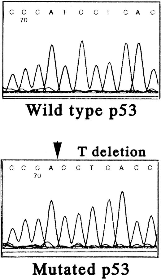 Fig. 4. Status of p53 in TF-1 AML cells. Amplicons from exon IV to exon IX of the p53 gene were obtained by PCR from genomic DNA of TF-1 AML cells, and the DNA was directly sequenced using appropriate sequencing primers. (A) The upper panel shows the wtp53 sequence of TF-1 cells, and the lower panel shows a 1 bp deletion at codon 251 in exon VI (ATC∅︀AC). (B) TF-1 cells were cultured for 2 days in fresh media with GM-CSF (1 ng/mL). After exposure to γ-irradiation (mock or 2.0 Gy), cells were cultured for an additional 2 hours or 16 hours . Total cell lysates from 5 × 106 viable cells/sample were immunoprecipitated with anti-p53 MoAb after 2 hours of culture and immunoblotted with horseradish peroxidase conjugated p53 MoAb. Similarly, cell lysates were immunoprecipitated with anti-p21 MoAb after 16 hours of culture and immunoblotted with anti-p21 MoAb. Equal protein loading was confirmed by IP and WB for actin. {/ANNT;4224n;;2112n;2112n}A {/ANNT;4224n;;2112n;124256n}B