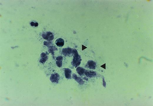 Fig. 1. The figure is taken from cytospin material of broncheo alveolar lavage fluid from patient no. 2. The accumulation of the proteinaceous material is depicted by arrows.