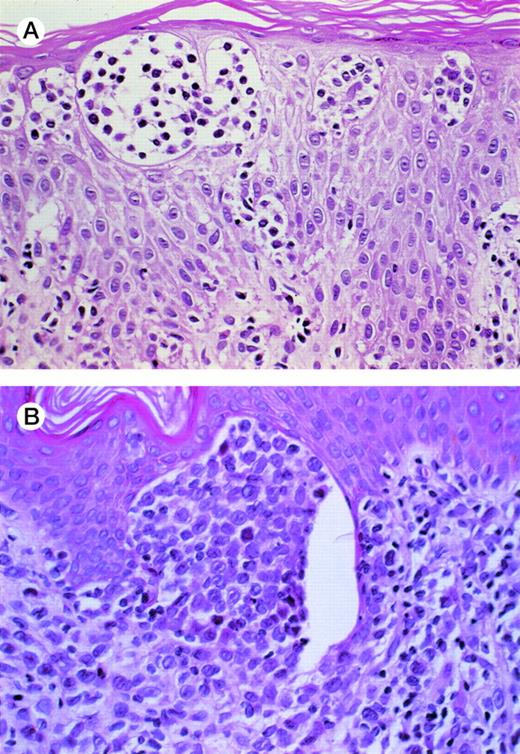 Fig. 2. (A) MF before transformation. The Pautrier’s microabscesses show intermediate-sized lymphocytes with hyperchromatic cerebriform nuclei. (B) MF after transformation. There is a micronodule in the papillary dermis composed of large lymphoid cells with clear vesicular nuclei and prominent nucleoli characteristic of large-cell transformation.