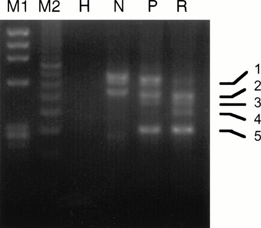 Fig. 3. Comparison of the gel electrophoretic pattern of RT-PCR products from the pretreatment and relapse specimens of case no. 9. PCR amplification used primer pair I as described in the Materials and Methods. M1, Hae III-digested ΦX 174 DNA; M2, 100-bp size standard; H, HL-60 cell RNA; N, NB4 cell RNA; P, pretreatment RNA; R, relapse RNA. PCR band 1, full-length V-form with PML breaksite at nt 1685; band 2, full-length product of comigrating atypical isoforms with breaksites at nts 1576 and 1581; band 3, same as band 1 but lacking exon 5 due to alternative splicing; band 4, same as band 2 but lacking exon 5; band 5, isoform lacking exons 5 and 6 due to alternative splicing.
