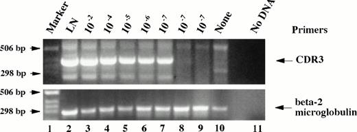 Fig. 2. An agarose gel showing the calibration of sensitivity for the seminested CDR3 PCR amplification. The amplification product has a length of approximately 350 bp. Cells from the malignant lymph node (which contained 80% tumor cells) were serially diluted into normal spleen cells down to 1 abnormal cell in 107 splenocytes. Three separate dilutions of 1 in 107 were tested. Normal spleen and no DNA controls are included. At the bottom are shown the same cDNA preparations amplified with beta-2 microglobulin primers as a control for quality of the cDNA and for gel loading.