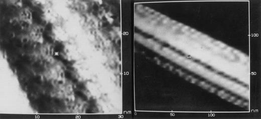 Deoxyhemoglobin S crystal. Chromatographically purified HbS (in 5 mmol/L KCl, 10 mmol/L Tris, pH 6.5) was deoxygenated, air-dried onto a graphite chip under a stream of nitrogen, and examined by scanning tunneling electron microscopy (STEM). Images at two levels of resolution are shown for a portion of a single crystalline bundle of HbS fibers that was 1,450 nm long and 65 nm in diameter. The size of the individual constituent subunits (6 × 5 nm) is consistent with their identity as hemoglobin tetramers. The vivid detail at the interface between tetramers (asterisk) suggests that STEM could be used to help define the fine structure of HbS polymers. (Courtesy of Mary M. Christopher, Yi Lin, Roy Matthew, D. Fennell Evans, and Robert P. Hebbel, Departments of Medicine and Chemical Engineering, University of Minnesota, Minneapolis, MN 55455.)