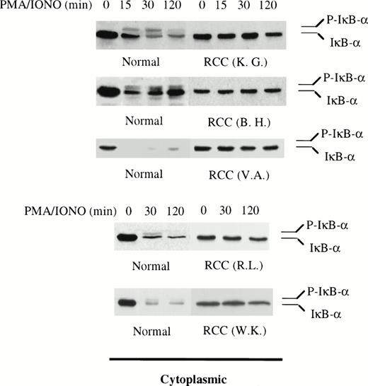 Fig. 2. Impaired IκB degradation in T cells derived from a subset of RCC patients. Western blotting for IκB was performed on cytoplasmic extract from patient T cells (n = 5). The levels of IκB in the remaining 2 patients (RH and LS) were determined by immunoprecipitating RelA and immunoblotting for IκB (data from RH presented in Fig 3). T cells from 5 different healthy donors served as positive controls. Densitometry analysis of IκB in T cells from normals showed a 73.4% (±6.7% SEM) and 68.5% (±11.3% SEM) decrease after 30 minutes and 2 hours of stimulation, respectively. In patient T cells, IκB levels decreased 10.1% (±4.9% SEM) after 30 minutes and 18.8% (±6.3% SEM) after 2 hours. The data presented here also showed that, within 15 to 30 minutes of stimulation, the phosphorylated form of IκB (P-IκB) was detected in normal T cells but not in patient T cells. In 1 normal, the phosphorylated form of IκB was not detected because of the rapid and total degradation of the inhibitor in 15 minutes.