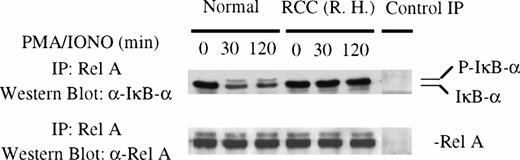 Fig. 3. Rel A protein was in complex with IκB in the cytoplasm of patient T cells and was insensitive to stimulation. Cytoplasmic extracts from control and patient T cells were immunoprecipitated with anti-RelA antibody and the immunoprecipitates were subjected to immunoblotting using anti-IκB and anti-RelA antibodies, respectively. In control immunoprecipitations, normal rabbit IgG was added to cytoplasmic extract from a healthy individual. Similar results were obtained with 2 additional patients.