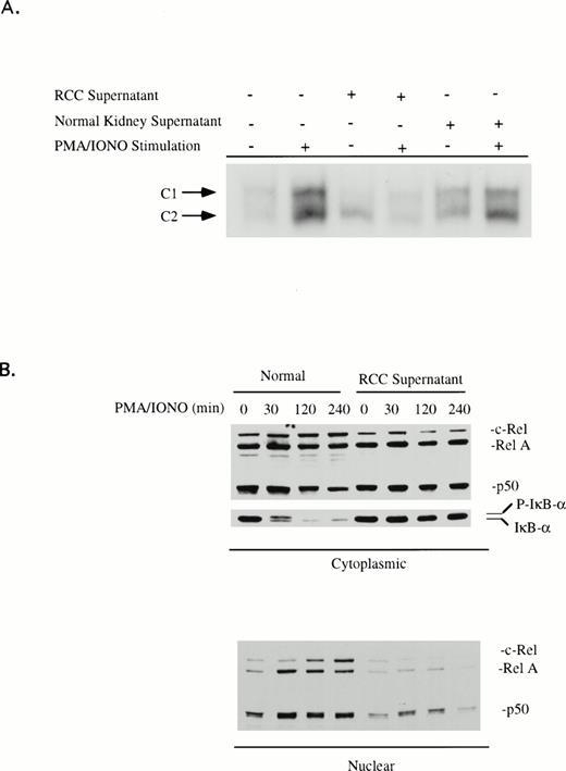 Fig. 6. (A) RCC tumor supernatant suppresses κB-specific binding activity. Human peripheral blood T cells from healthy volunteers were cultured in medium, RCC-S, or NKC-S for 18 hours and then stimulated with PMA (20 ng/mL)/ionomycin (0.75 μg/mL) for 2 hours. Nuclear extracts were isolated and EMSA assays were performed with the oligonucleotide that corresponds to the κB sequence of the IL2R gene. (B) T cells from the healthy donor were cultured with medium or RCC-S for 18 hours and then stimulated with PMA (20 ng/mL)/ionomycin (0.75 μg/mL) for the times indicated. The nuclear and cytoplasmic extracts were prepared and then analyzed by immunoblotting for RelA, c-Rel, NFκB1 (p50), and IκB. Suppression of NFκB activation was observed in 12 of the 16 RCC-S. In addition, 6 of 11 RCC-S tested inhibited IκB phosphorylation and suppressed IκB degradation.