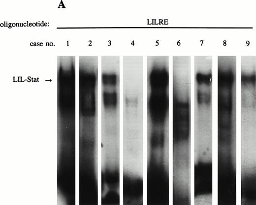 Fig. 3. LIL-Stat is constitutively activated in nuclear extracts of seven out of nine AML cases. (A) Five micrograms of nuclear proteins from nine AML cases were incubated with 32P-labeled LILRE oligonucleotide for determination of constitutive LIL-Stat binding. (B) Similar to the above-mentioned experiment, nuclear extracts of nine AML cases were band-shifted with the Stat3-specific oligonucleotide.