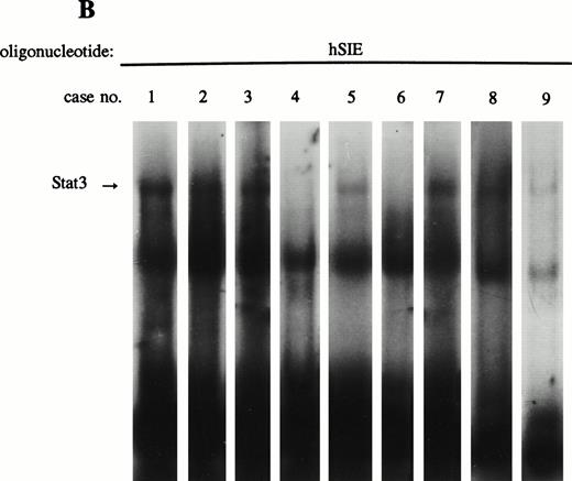 Fig. 3. LIL-Stat is constitutively activated in nuclear extracts of seven out of nine AML cases. (A) Five micrograms of nuclear proteins from nine AML cases were incubated with 32P-labeled LILRE oligonucleotide for determination of constitutive LIL-Stat binding. (B) Similar to the above-mentioned experiment, nuclear extracts of nine AML cases were band-shifted with the Stat3-specific oligonucleotide.