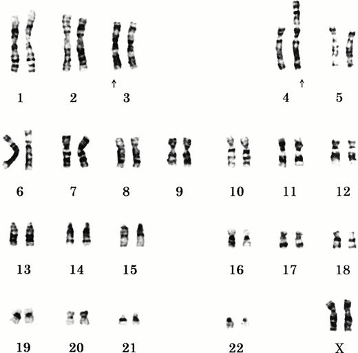 Fig. 5. Karyotype of the NK-YS cells. The karyotype is 46, XX, add (3) (q26.2), der(4)t(1;4)(q12;p16) according to the ISCN system.
