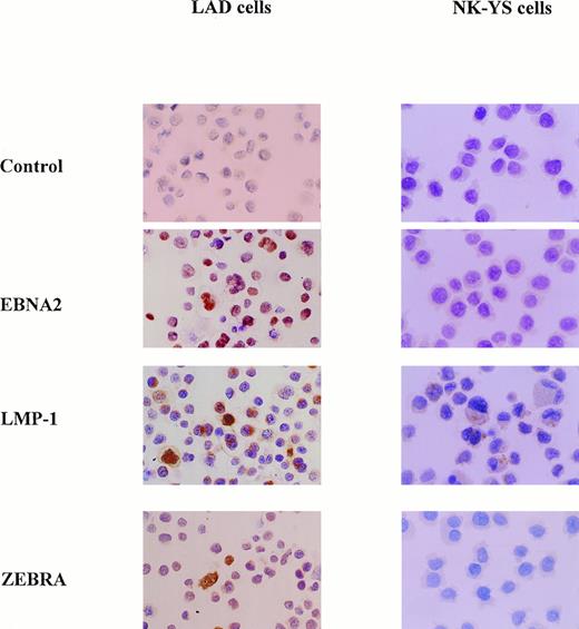 Fig. 8. Expression of EB viral latent proteins by NK-YS cells and by LAD cells used as a positive control. The LAD cells expressed EBNA-2, LMP-1, and ZEBRA proteins. NK-YS cells expressed a low level of LMP-1, but no EBNA-2 or ZEBRA protein (original magnification × 200).