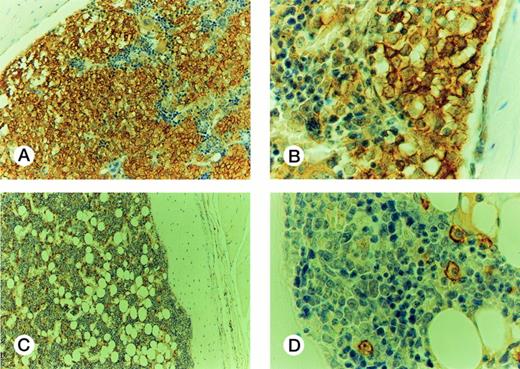 Fig. 5. Histology of murine BM engrafted with CML cells. Engraftment with BP cells: (A) The marrow is infiltrated by sheets of huCD45+ cells, with some residual huCD45-negative maturing hematopoietic elements; (B) The infiltrating cells are large, nucleolated blasts with strong surface immunoreactivity for huCD45. The smaller maturing erythoid elements are negative. Murine BM engrafted with CP cells: (C) the marrow contains frequent dispersed huCD45+ cells, comprising about 10% of the cellularity. The remaining huCD45-negative marrow elements appear normal. (D) The huCD45+ cells are medium sized mononuclear cells with round to oval nuclei and abundant pale cytoplasm. They are dissimilar from the blasts seen in (B).