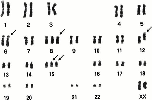 Fig. 1. G-banded karyotypes of a leukemia cell. Structurally abnormal or additional chromosomes are shown by arrows.
