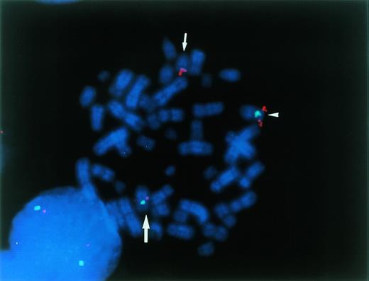 Fig. 2. The mapping of YAC 964c10 (red) and cosmid D12Z3 (green) to a leukemia cell. The latter is a centromere probe for chromosome 12. The normal and rearranged chromosome 12 are indicated by an arrowhead and a large arrow, respectively. der(15) chromosome is identified with a short arrow. YAC 964c10 hybridized to the normal chromosome 12 and der(12) as well as to the der(15) chromosome. Signals on the der(12) are smaller than those on the other chromosomes