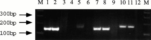 Fig. 2. Detection of the ZNF198/FGFR1 fusion product in patient SR13 and somatic cell hybrid RBF1.6First-strand cDNA synthesis was generated from 1 μg of total RNA, using random hexamers as primers according to standard protocols. Oligonucleotides were designed to sites in the ZNF198 and FGFR1 cDNA flanking the translocation breakpoints: ZNF198F (5′-ccctgtgcctgtgtatatcccag-3′), ZNF198R (5′-tgcaggaatcttctcactgc-3′), FGFRX7F (5′-gatcatcgtctacaagatg-3′), and FGFR1979R (5′-gtgatggccgaaccagaagaac-3′). Lanes 1 and 2, ZNF198/FGFR1 fusion products detected in RBF1 and SR, respectively, by primers ZNF198F/FGF1979R. Lanes 4 and 5, potential FGFR1/ZNF198 fusion products detected by primers FGFX7F/ZNF198R in RBF1 and SR. Lanes 7 and 8, expression of the normal ZNF198 mRNA in RBF1 and SR, detected using primers ZNF198F/ZNF198R. Lanes 10 and 11, FGFR1 expression in RBF1 and SR, respectively, detected with primers FGFRX7F/FGF1979R. Lanes 3, 6, 9, and 12, negative controls.