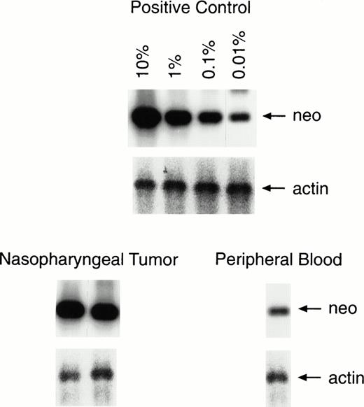 Fig. 3. Semiquantitative PCR analysis of lymphocytes infiltrating the tumor and in peripheral blood. One percent of the lymphocytes infiltrating the second nasopharyngeal biopsy was positive for the marker gene, compared with a level of 0.01% to 0.001% in a peripheral blood sample taken on the same day. The results of PCR analysis for the actin gene are provided for comparison of equal amounts of DNA.
