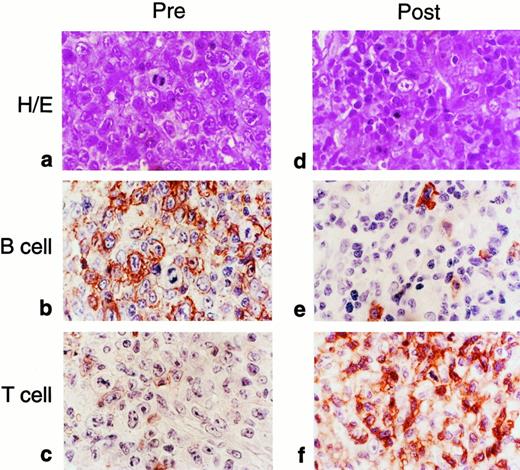 Fig. 1. Comparison of tumor biopsy samples before and after adoptive T-cell therapy for EBV lymphoma in an 11-year-old boy who had undergone allogeneic bone marrow transplantation from a matched unrelated donor. The initial specimen had the histologic appearance of immunoblastic lymphoma (a; hematoxylin and eosin). Most of the cells reacted to staining for the CD20 B-cell marker (b), whereas a few were positive for the T-cell marker (c). After adoptive immunotherapy, the follow-up biopsy showed an infiltrate of smaller lymphocytes, the majority of which reacted with the T-cell marker (d through f).