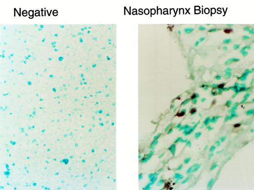 Fig. 2. In situ PCR analysis of tumor-infiltrating lymphocytes illustrated in Fig 1d through f. The neo gene was detected in 1% of the infiltrating lymphocytes, a rate that corresponds to the gene-marking efficiency for the EBV-specific T-cell line administered to this patient.