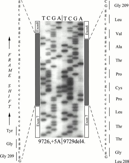 Fig. 3. Sequencing of abnormally spliced cDNA. The gray box indicates the inserted sequences. The 11 additional residues inserted between Leu208 and Gly209 and the frame-shifting after Gly209 are indicated.
