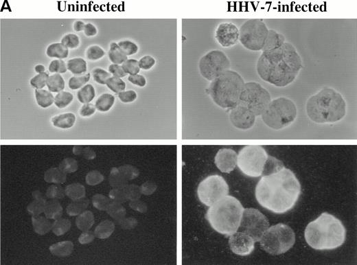 Fig. 5. Immunofluorescence analysis of HHV-7 antigen (A) and cyclin B (B) expression in uninfected and HHV-7–infected SupT1 cells. The same cells are viewed by phase contrast microscopy (top panels) and fluorescence microscopy (bottom panels). In (A), note that enlarged cells, characteristic of HHV-7 infected cultures, are positively stained for expression of viral antigens. In (B), note that, whereas cyclin B expression is heterogenous among small cells, enlarged HHV-7–infected cells always exhibit an intense staining for cyclin B. Original magnification × 400. Representative fields are shown.