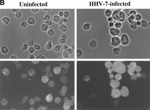 Fig. 5. Immunofluorescence analysis of HHV-7 antigen (A) and cyclin B (B) expression in uninfected and HHV-7–infected SupT1 cells. The same cells are viewed by phase contrast microscopy (top panels) and fluorescence microscopy (bottom panels). In (A), note that enlarged cells, characteristic of HHV-7 infected cultures, are positively stained for expression of viral antigens. In (B), note that, whereas cyclin B expression is heterogenous among small cells, enlarged HHV-7–infected cells always exhibit an intense staining for cyclin B. Original magnification × 400. Representative fields are shown.