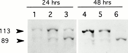 Fig. 4. LMP-1 antisense oligodeoxynucleotide treatment induces cleavage of PARP. Western blot analysis of PARP expression in the EBV-positive lymphoblastoid cell line, X50-7, was performed after exposure to unmodified oligodeoxynucleotide in serum-free medium with liposomes for 24 and 48 hours. Lanes 1 and 4, untreated controls; lanes 2 and 5, control oligodeoxynucleotide (SS1)-treated; lanes 3 and 6, LMP-1 antisense-treated. The 113-kD PARP and its 89-kD cleavage product are indicated (arrows).