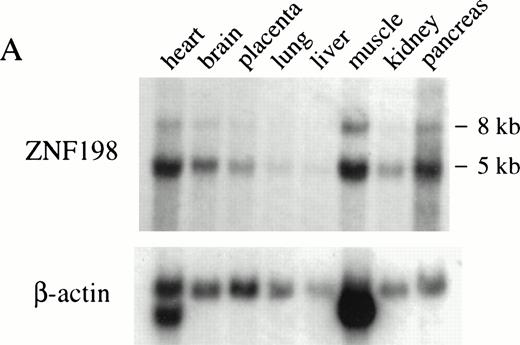 Fig. 3. (A) Multiple tissue Northern blot probed with ZNF198 and β-actin. A major ZNF198 transcript of 5.0 kb and a minor transcript of 8.0 kb is seen in all tissues tested. (B) Southern blot ofBglII or EcoRI digested patient and control (CML) DNA probed with ZNF198. Rearrangements are seen for all five patients.