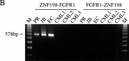 Fig. 5. (A) The sequence surrounding the ZNF198-FGFR1 fusion. Proline 913 of ZNF198 is joined to valine 429 of FGFR1.39FGFR1 sequence is underlined. (B) RT-PCR analysis showing the presence of ZNF198-FGFR1 fusion transcripts (578 bp) in patients P.R., J.B., and E.C. but not three patients with CML. Reciprocal FGFR1-ZNF198 transcripts were not detected in any individual. M, 123-bp ladder. (C) (i) Expression of normal ZNF198 (527 bp) and normal FGFR1 (534 bp) in patients P.R., J.B., and E.C. (ii) RT-PCR using (A) primers DET22 + DET26 (564 bp), (B) DET17 + DET26 (395 bp), and (C) DET17 + DET22 + DET26 (564 bp).