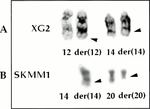 Fig. 3. The t(12;14)(q24;q32) (A) and the t(14;20)(q32;q11) (B) translocations by G-banding.