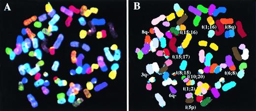 Fig. 1. A metaphase spread for the cell line XG4 after simultaneous hybridization of 24 combinatorially-labeled chromosome painting probes. (A) Shows display colors and (B) shows spectra-based colors (see Materials and Methods for explanation). Abnormal chromosomes are identified and their derivation has been noted in (B).