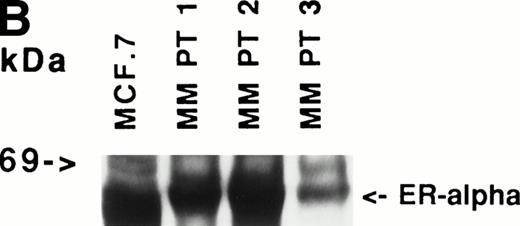 Fig. 1. Expression of estrogen receptor on MM cell lines and MM patient cells. Lysates from ARH-77, OCI My-5, RPMI 8226, S6B45, and U266 MM cells (A) as well as purified MM cells from 3 patients (B) were examined by Western immunoblotting for the presence of ER- using the TE1115011 MoAb. MCF-7 breast cancer cells and DU145 prostatic cancer cells served as positive and negative controls, respectively, for ER- expression. Immunoblotting with anti–tubulin- MoAb assured equivalent protein loading.