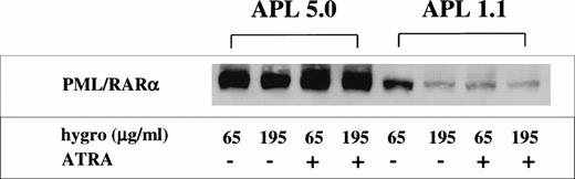 Fig. 4. Western analysis for PML/RAR expression in ribozyme-transfected NB4-R1 cells. NB4-R1 cells transfected with either the control ribozyme, APL 5.0, or the catalytic ribozyme, APL 1.1, were cultured in 65 or 195 μg/mL hygromycin (hygro) in the absence (−) or presence (+) of 10−6 mol/L ATRA for 5 days. Total cellular protein was extracted and analyzed by Western analysis, using an anti-RAR antibody to detect PML/RAR protein. Relative to APL 5.0 transfectants, this immunoblot indicates that a marked reduction of PML/RAR expression occurs in APL 1.1-transfected NB4-R1 cells, especially after ATRA treatment and selection at the 195 μg/mL hygromycin dosage.