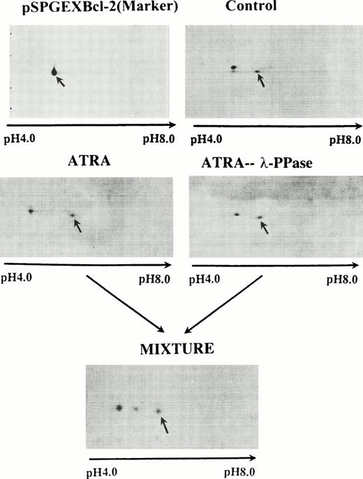 Fig. 1. 2D gels; upper left is the bacterially synthesized marker protein, shown throughout the figures as an arrow. Upper right is a 2D gel of a control lysate from OCI/AML-5 cells. Middle left is 2D gel of a lysate from ATRA-treated cells, showing the acidic isoform. Middle right is a 2D gel of an aliquot of lysate from ATRA-treated cells, digested with λ-phosphatase. It may be compared with the 2D control gel directly above it in the figure. The 2D gel at the bottom of the figure was made from a mixture of the two lysates above it; it shows the marker, a spot at the position of the native protein, but derived from λ-phosphatase–digested lysate from ATRA-treated cells and an acidic isoform, derived from the ATRA-treated cells.