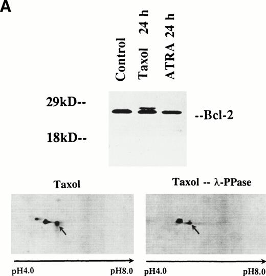 Fig. 2. (A) At the top is a 10% to 20% gradient gel showing the presence of a slower-moving isoform of bcl-2 from cells treated with taxol (middle lane). The control (left lane) and lysate from ATRA-treated cells show only a single band (right lane). The bottom is 2D gels from taxol-treated cell lysate (left) and the lysate after digestion with λ-phosphatase. These conditions permit the demonstration of the slightly larger than control molecular weight of the phosphorylated bcl-2 isoform seen after taxol. (B) Lysates from ATRA- and taxol-treated cells (above) were mixed and the mixture run as a 2D gel (below). The experiment shown is representative of two replicates.