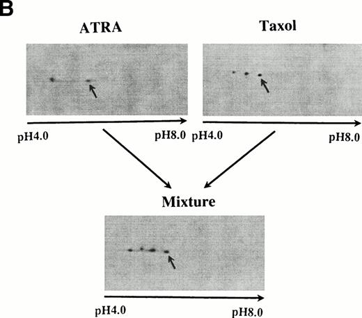 Fig. 2. (A) At the top is a 10% to 20% gradient gel showing the presence of a slower-moving isoform of bcl-2 from cells treated with taxol (middle lane). The control (left lane) and lysate from ATRA-treated cells show only a single band (right lane). The bottom is 2D gels from taxol-treated cell lysate (left) and the lysate after digestion with λ-phosphatase. These conditions permit the demonstration of the slightly larger than control molecular weight of the phosphorylated bcl-2 isoform seen after taxol. (B) Lysates from ATRA- and taxol-treated cells (above) were mixed and the mixture run as a 2D gel (below). The experiment shown is representative of two replicates.